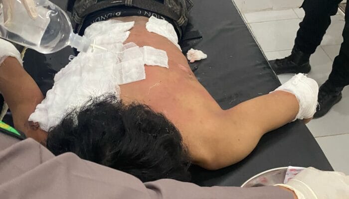 Insiden Demonstrasi Pecat Kapolda Kaltara, Dua Kader HMI Diduga Sengaja Dibakar Polisi